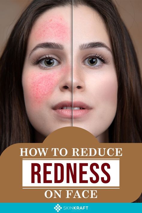 How To Reduce Redness Of Face Red Cheeks Remedy, How To Reduce Redness On Face, Face Redness Remedy, Red Rash On Face, Skin Irritation Remedies, Red Spots On Face, Redness Remedy, Reduce Face Redness, Redness Reducing Skin Care