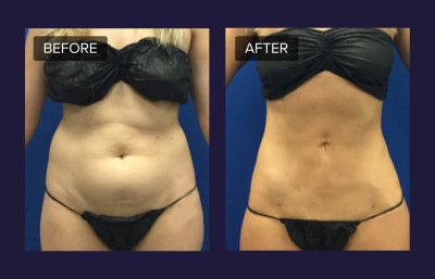 Laser Liposuction: What Is It? How Does It Work? Is It Safe? [FAQ] Lipo B12 Injections Before And After, Lipolysis Injections Before And After, Lipo360 Before And After, Laser Lipo Before And After, Lipo 360 Before And After, Botox Injection Sites, Injection Sites, Lipo Before And After, Botox Injection