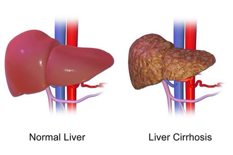 Detox Your Liver, Full Body Detox, Detox Diet Plan, Liver Failure, Healthy Liver, Liver Detox, The Liver, Detox Cleanse, Alternative Medicine