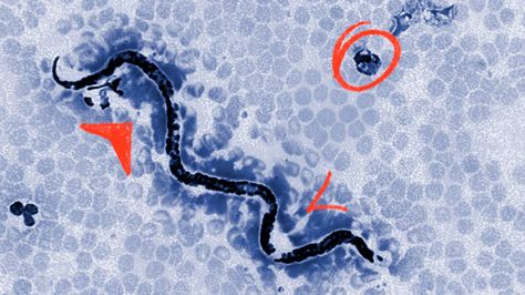 Types of human parasite: Worms, infections, and causes Parasitic Worms In Humans, Human Parasites Pictures, Parasites In Humans, Parasite Pictures, Parasites Symptoms, Liver Fluke, Diseases Pictures, Human Tongue, Types Of Worms