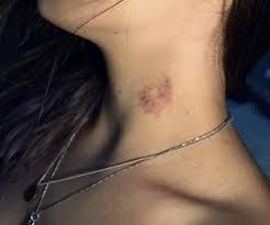 hickey Photo Hickey, Hickies Neck And Chest, Aesthetics Hickeys, Hickies Neck Aesthetic, Hickies Neck, Neck Aesthetic, Girlfriend Goals, Aesthetic Women, Couples Goals