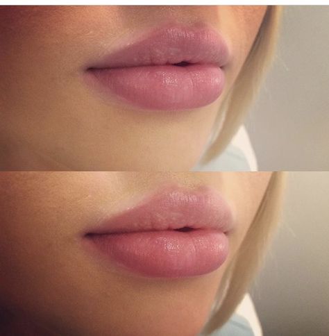 Beautiful lips maintained with 1/2 syringe by Laura Riehl-Tonn RN Pillow Lips Injections, 2 Syringes Of Lip Filler, Lip Filler 1 Syringe, Bottom Lip Filler, 1 Syringe Lip Filler Before And After, Lip Filler 1 Ml, Half Syringe Lip Filler Before And After, 1 Ml Lip Filler, Lip Injections Shapes