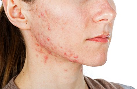 ICYMI: Prebiotic combination shows metabolic benefits for adults with acne: Pilot data Jawline Acne, Nodular Acne, Neck Acne, Acne Vulgaris, Types Of Acne, Acne Causes, Hormonal Acne, Acne Breakout, Cystic Acne