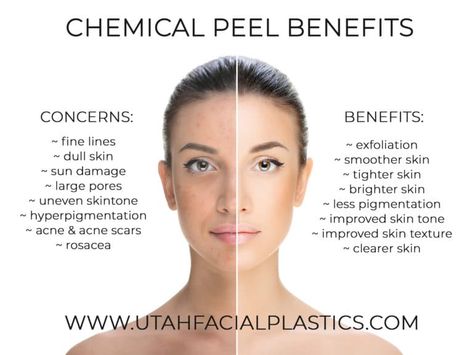 After Chemical Peel Care, Chemical Peel Marketing, Benefits Of Dermaplaning, Chemical Peel Aesthetic, Chemical Peel Benefits, Hydrafacial Benefits, Esthetics Marketing, Environ Skincare, Chemical Face Peel