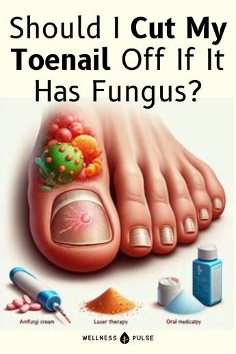 Learn about the time frame needed for hydrogen peroxide to eradicate toenail fungus. Visit our website for detailed insights and guidance. Nail Health Signs, Toenail Care, Homemade Nail Polish, Toenail Health, Toenail Fungal Infection, Nail Remedies, Fingernail Fungus, Nail Conditions, Toenail Fungus Remedies