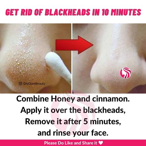 Health Bars, How To Remove Blackheads, For Blackheads, To Remove Blackheads, Rid Of Blackheads, Bead Matted, Honey Cinnamon, Health Bar, Tech Business