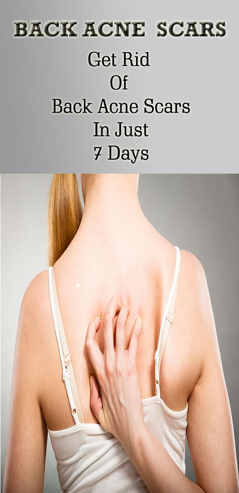 Back Acne Scar Removal, Acne Scar Removal For Oily Skin, Ways To Remove Acne, How To Get Rid Of Scars From Acne, How To Remove Acne Scar Marks, Skincare For Acne And Scars, Rid Of Back Acne, Get Rid Of Back Acne, Best Home Remedy For Acne Scar