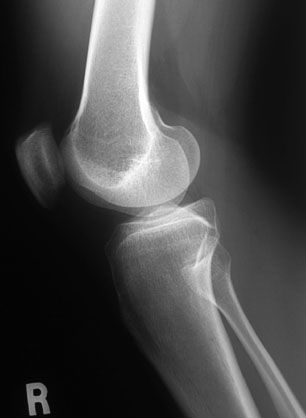 Radiographic Anatomy of the Skeleton: Knee -- Lateral View, Unlabelled Radiographic Anatomy, Knee Dislocation, The Skeleton, Sample Resume, Anatomy, Skeleton