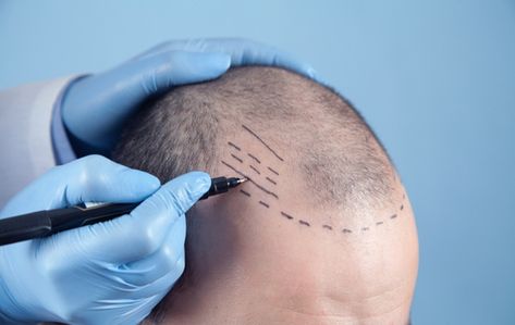 Hair Transplant Myths and Facts: Common Misconceptions Hair Medicine, Hairline Tattoos, Micro Pigmentation, Hair Implants, Hair Transplant Cost, Hair Plugs, Hair Transplant Procedure, Dunner Wordend Haar, Scalp Micropigmentation