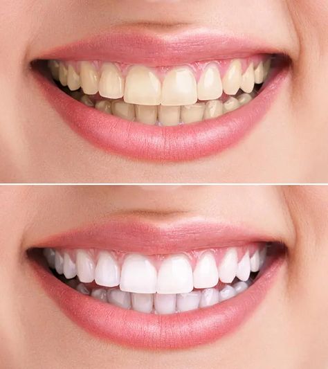 Hydrogen Peroxide For Teeth Whitening – 6 Home Remedies To Whiten Teeth Teeth Whitening Remedies, Laser Teeth Whitening, Whiter Teeth, Loose Tooth, Teeth Whitening Pen, Best Teeth Whitening, Natural Teeth Whitening, Teeth Whitening Kit, Whitening Kit