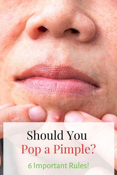 You're not supposed to pop pimples. But if you have to, then please do it in these six steps. Should You Pop Pimples, How To Pop A Pimple Under The Skin, Diy Hair Care Products, Neck Pimples, Natural Remedies For Acne, Popping Pimples, Face Masks Diy, Clear Skin Routine, Blind Pimple