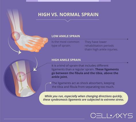 High Vs. Normal Sprain Sprained Ankle Remedies, Ankle Sprain Recovery, High Ankle Sprain, Ankle Injuries, Knee Strengthening, Ankle Sprain, Knee Strengthening Exercises, How To Strengthen Knees, Ankle Pain