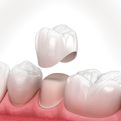 Dental Crown Procedure, Dental Restoration, Dental Implants Cost, Dental Bridge, Dental Crowns, Family Dental, Dental Procedures, Natural Teeth, Cosmetic Dentistry