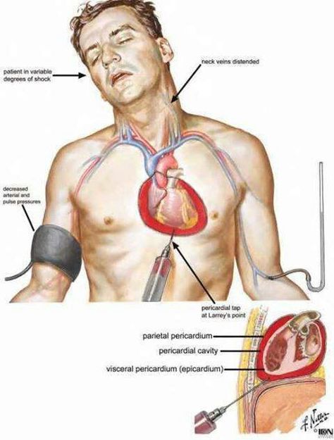 Cardiac Tamponade Cardiac Tamponade, Anatomy Of The Heart, Internal Anatomy, Medical Terminology Study, Cardiac Nursing, Nursing School Tips, Medical Terminology, Medical Coding, Critical Care