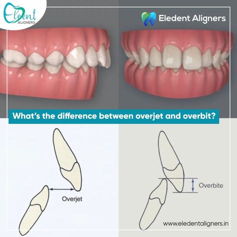 Welcome to the Eledent Aligners Insight Series, where we embark on a journey to explore the world of clear aligners and their transformative power for your smile. In our inaugural episode, we delve into the basics of aligner technology, sharing expert insights and real-life experiences that highlight the benefits of choosing Eledent. Angle Classification Teeth, Overjet Overbite, Overbite Teeth, Dental Notes, Naruto Poster, After Braces, Buck Teeth, Dental Hygiene School, Dental Technician