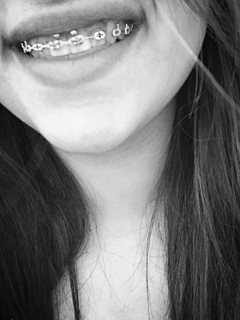 Smiley piercing with braces Braces And Smiley Piercing, Smiley Piercing With Braces, Smile Piercing, Orthodontic Appliances, Pinterest Jewelry, Brace Face, Smiley Piercing, Face Piercings, Facial Piercings