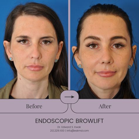 Beautiful results of an endoscopic brow lift! This procedure can do wonders to brighten the eyes, restore a relaxed, friendly expression, and smooth away heavy, encroaching frown lines, wrinkles and folds. Contact us today! 212.229.1100 info@eskmd.com #drkwak #dredwardskwak #nycplasticsurgeon #plasticsurgery #plasticsurgeon #cosmeticsurgery #cosmeticsurgeon #facialaesthetics #facialplastics #aesthetics #browliftsurgery #browlift #endoscopic #eyelids #naturalenhancement #beforeandafter Endoscopic Brow Lift, Brow Lift Surgery, Frown Lines, Eyelid Lift, Facial Plastic Surgery, Facial Aesthetics, Brow Lift, Facial Plastic, Plastic Surgeon