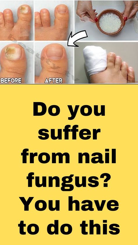 Ugly Toenails, Infected Toenail, Toenail Health, Toenail Fungal Infection, Nail Remedies, Toenail Fungus Remedies, Nail Fungus Remedy, Nail Infection, Fungal Nail