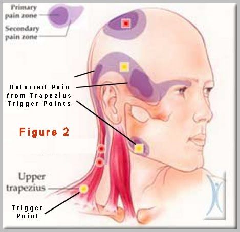 Punkty Spustowe, Forward Head Posture Exercises, Occipital Neuralgia, Referred Pain, Massage Therapy Techniques, Jaw Pain, Trigger Point Therapy, Head Pain, Spine Health