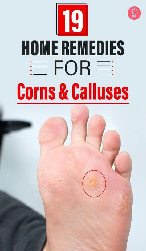 Get Rid Of Corns, Corn Removal, Health Signs, Tongue Health, Natural Sleep Remedies, Natural Cough Remedies, Cold Remedies, Unwanted Hair Removal, Nail Fungus