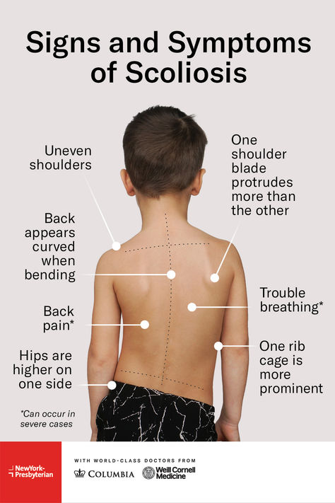 #Scoliosis is a treatable condition characterized by an abnormal curvature of the spine that is often detected between the ages of 10 and 15. Dr. Michael Vitale, Chief of Pediatric Spine Surgery with #OchSpine at #NYPMorganStanley, explains the importance of early diagnosis and shares the signs to look out for. Tap the link to learn more this #ScoliosisAwarenessMonth. Spine Curvature, Spine Care, Cervical Spondylosis, Medical Photography, Healthy Spine, Spine Surgery, Human Species, Signs And Symptoms, The Signs