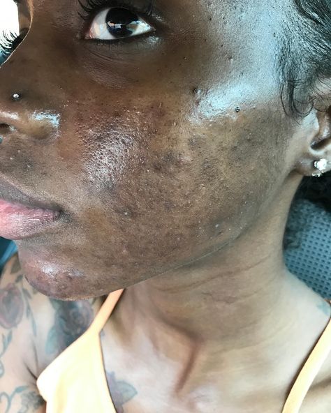 I used to suffer from hormonal & cystic acne. From around 2007-2019 I was going back & forth to the dermatologist. It was hell. My skin got worst & worst. The scarring, the dark spots, the texture, the enlarged pores & inflammation put me in a terrible mental health crisis at times. I was caking on makeup & picking my skin every single day. I went & got shots at the derm for the under the skin cysts several times a month. I spent 1,000s of dollars...I even tried #accutane but I relapsed. It g... Hormonal Cystic Acne, Blackheads On Cheeks, Big Zits, Pimples On Scalp, Bad Skin, Bad Acne, Beauty Hacks Skincare, Skin Aesthetics, Bleaching Cream