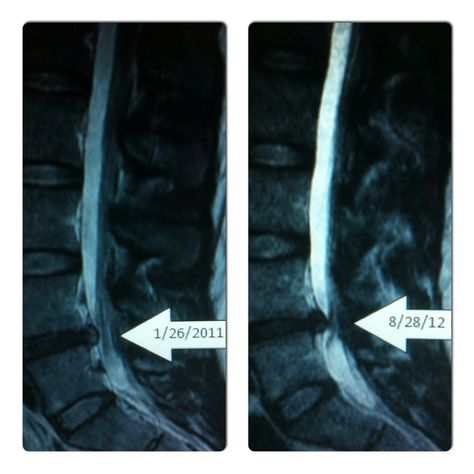 MRI of Bulging L4/L5 disc on nerve. Herniated Disk L5 S1, Lumbar Mri Anatomy, Degenerating Disc Disease, Mri Brain Scan, Lumbar Disc, Bulging Disc, Chi Gong, Back Pain Relief, Sciatica