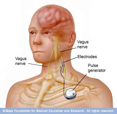 Vagal Nerve, Vagus Nerve Stimulator, Yoga Breathing Techniques, Dravet Syndrome, Nervus Vagus, Nerve Health, Gut Brain, Vagus Nerve, Weight Control