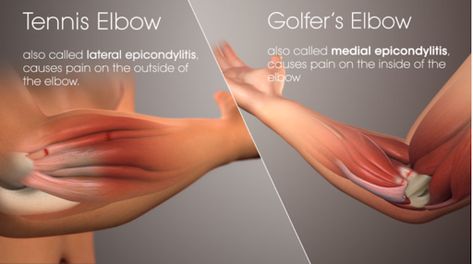 Elbow Exercises, Elbow Pain Relief, Arm Brace, Ulnar Nerve, Pain Relief Gel, Elbow Brace, Golfers Elbow, Kt Tape, Hip Problems