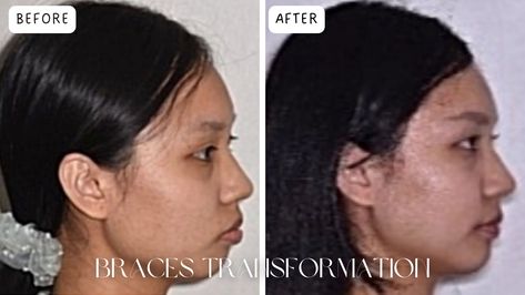 How To Fix Side Profile, Overbite Braces, Overbite Before And After, Before And After Braces, Braces Transformation, Braces Before And After, After Braces, Short Dyed Hair, Side Profile