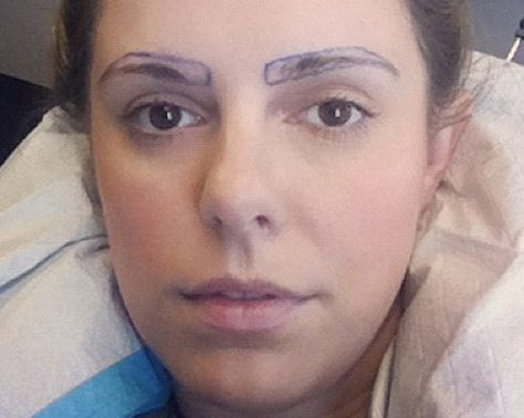 The True (And Oddly Fascinating) Story Of Eyebrow Transplants Eyebrow Hair Transplant, Eyebrow Transplant, Types Of Eyebrows, Laser Tattoo Removal, Skin Clinic, Shaved Head, Tummy Tucks, Tattoo Removal, Hair Restoration