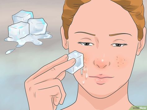 3 Ways to Get Rid of a Pimple with No Head - wikiHow Hard Pimple, Deep Pimple, Nodule Acne, Back Pimples, Painful Pimple, Pimples On Forehead, Cystic Pimple, Blind Pimple, Forehead Acne