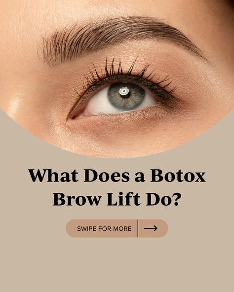 Botox Eyebrow Lift Before And After, Eyebrow Lift Botox Before And After, Botox Brow Lift Before And After, Eye Brow Lift, Botox Benefits, Botox Eyebrow Lift, Botox Injection Sites, Allergan Botox, Injection Sites