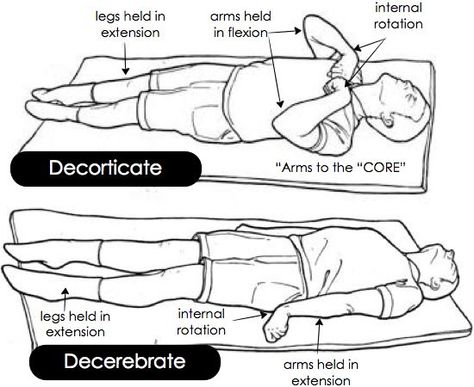 Decerebrate and decorticate posturing Intracranial Regulation Nursing, Decorticate Vs Decerebrate, Cna School, Associates Degree In Nursing, Nursing School Scholarships, Nursing School Prerequisites, Nursing Assessment, Family Nurse Practitioner, Best Nursing Schools