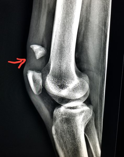 Knee Xray, Broken Knee Cap, Broken Knee, Knee Cap, X Rays, Auto Insurance Quotes, Radiology, Outdoor Design, X Ray