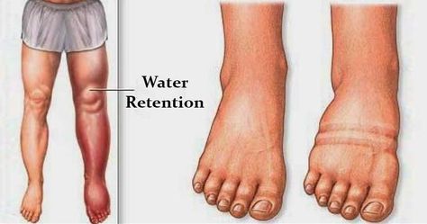 The water retention is this condition when your feet, hands, ankles, or legs get swollen. It usually visible when you sit for too long. Well, it’s not about you not getting up often to get that water and blood flow going. This happens when the fluids accumulate in the tissues, cavities, and circulatory system. The leading cause of water retention or edema are pregnancy, premenstrual syndrome, not being physically active, certain medications, and sedentary lifestyle. However, swelling can come... Water Retention Causes, Water Retention Remedies, Physical Inactivity, Swollen Legs, Sedentary Lifestyle, Fluid Retention, Water Weight, Circulatory System, Water Retention