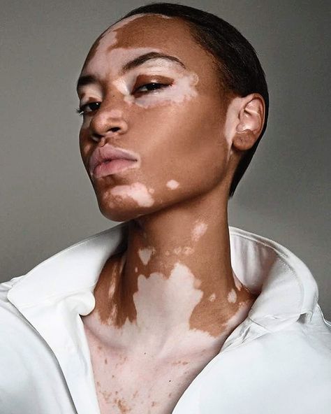 VITILIGO AWARENESS MONTH: WHAT IS VITILIGO? — New River Dermatology Skin Grafting, Skin Disorders, The Jacksons, Unwanted Hair Removal, Unwanted Hair, Medical Prescription, Dermatology, Halle, Anton