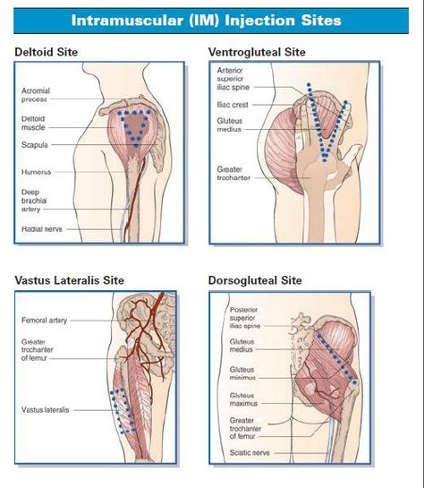 Intramuscular (IM) Administration Im Injection Sites, Med Surge, Im Injection, Injection Sites, Nursing Knowledge, Pharmacology Studying, Medical Assisting, Nurse Things, Nursing Information