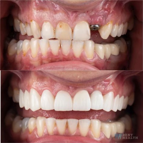 Dental Implants Before And After, Dental Implant Procedure, Missing Teeth, Teeth Implants, Dental Art, Dental Implant, Perfect Smile, After Photos, Dental Implants