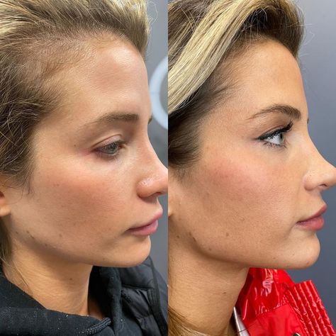 Jaw And Cheek Filler, Chin And Cheek Fillers, Chin Implants Before And After, Chin Enhancement Before After, Naomi Southern Charm Hair, Naomie Olindo Hair, Cheek And Chin Fillers Before After, Jaw And Chin Filler Before And After, Naomi Olindo Style