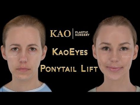 Facelift Without Scars? The Future of Plastic Surgery? Ponytail Lift or Ponytail Facelift? - YouTube Ponytail Lift, Facelift Before And After, Face Lift Surgery, I Knew It, Face Lift, Look Beautiful, Summer Makeup, Plastic Surgery, Picture Perfect