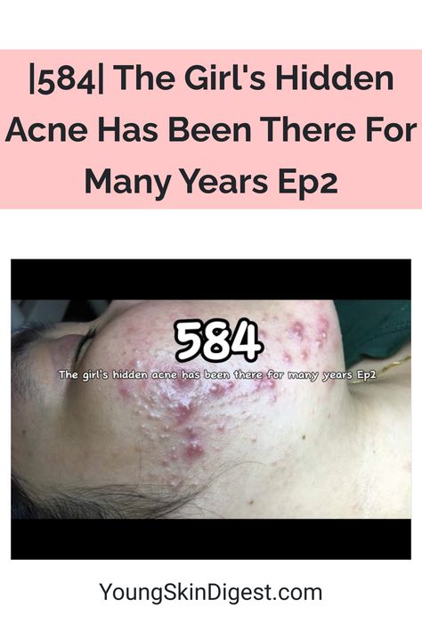 |584| The Girl's Hidden Acne Has Been There For Many Years Ep2 Acne Recipes, Acne Removal, Natural Acne Remedies, Natural Acne, Severe Acne, Acne Causes, Cystic Acne, Environmental Factors, Acne Remedies