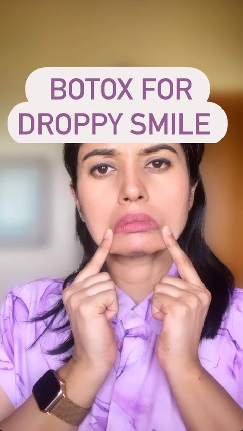 People say I look so happy ❤️and I say that’s the BOTOX ❤️ Botox can improve your quality is life ,not just your wrinkles ❤️ People refer… | Instagram Botox In Smile Lines, Corners Of Mouth Turned Down, Person Pulling Mouth Reference, Botox For Frown Lines, Botox To Lift Corners Of Mouth, Botox Marionette Lines, Botox For Downturned Mouth, Botox For Smile Lines, Smile Lift Botox Before And After