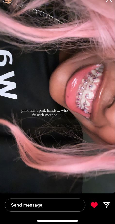 Braces Aethstetic, Pink Braces Black Women, Braces Colours For Brown Skin, Dark Pink Braces, Cute Braces Colors For Brown Skin, Pink Braces Aesthetic, Cute Braces Colors For Light Skin, Braces Colors Ideas Dark Skin, Light Pink Braces