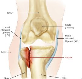 Tibial Plateau Fracture, Orthopedic Surgery, Surgery Center, Patient Education, Physician Assistant, Wound Care, After Surgery, Sports Medicine, Physical Therapy