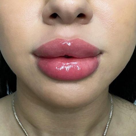 Big Lip Filler, Big Lips Aesthetic, Desired Lips, Lip Filler Inspiration, 1ml Lip Filler, Dermal Fillers Lips, Big Lips Natural, Fairy Eyes, Heart Shaped Lips