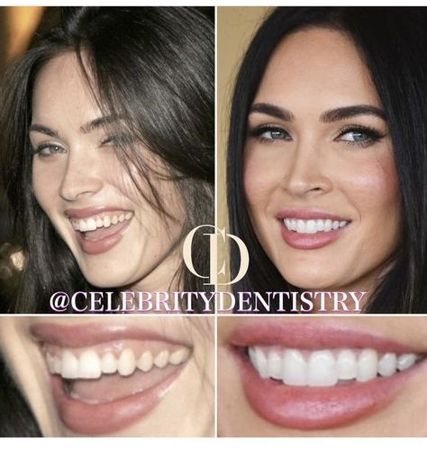 Teeth Makeover, Perfect Smile Teeth, Romantic Perfume, Teeth Aesthetic, Dental Bonding, Veneers Teeth, Beautiful Teeth, Cosmetic Injectables, Perfect Teeth