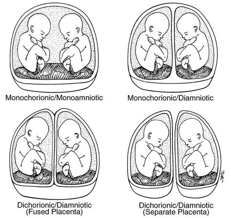 Pregnancy Getting Pregnant With Twins, Midwifery Student, Multiple Births, Medical Sonography, Diagnostic Medical Sonography, Student Midwife, Multiples Baby, Pregnant With Twins, Ob Nursing