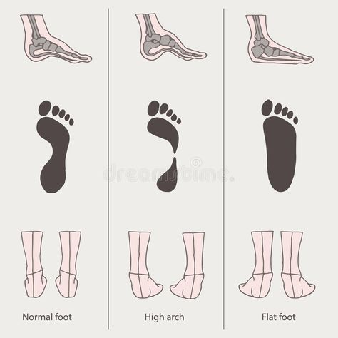 Flat foot, high arch. Medical illustration, flat foot, high arch , #spon, #high, #foot, #Flat, #arch, #flat #ad Flat Feet Exercises, Shoes For High Arches, Foot Anatomy, Fallen Arches, Foot Exercises, Health Hacks, Thai Massage, Medical Illustration, Foot Health