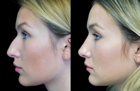 Blake Lively Nose, Bad Nose Jobs, Closed Rhinoplasty, Nose Plastic Surgery, Nose Surgery Rhinoplasty, Hooked Nose, Crooked Nose, Bulbous Nose, Nose Jobs